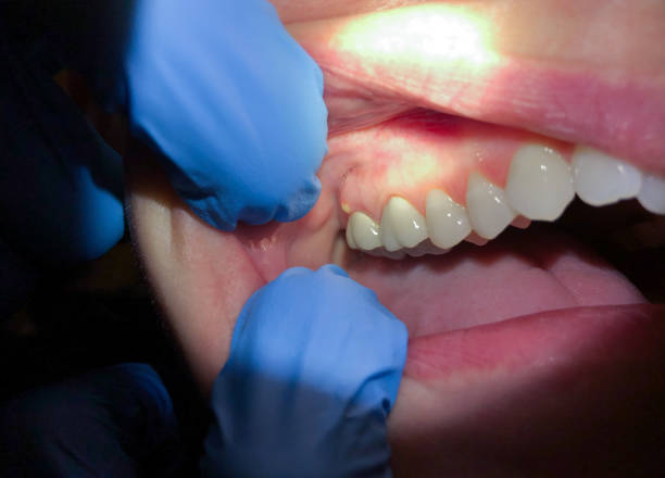 Best Tooth Infection Emergency Dentist  in West Point, GA